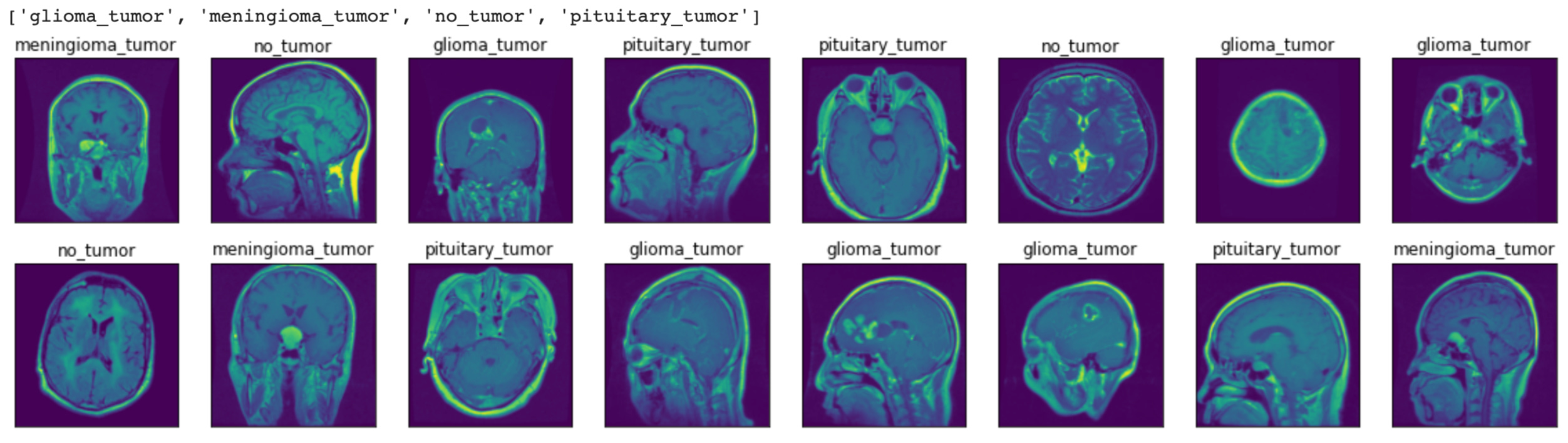Brain Tumor Classification